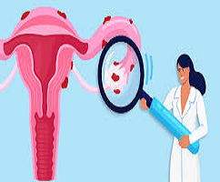 ¿Qué es la Endometriosis?